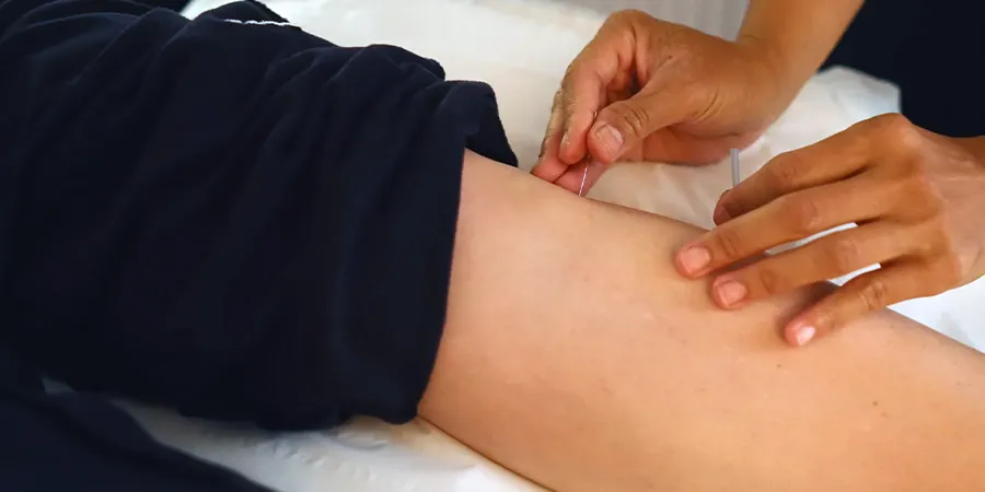 Person receiving acupuncture treatment for help with stress relief